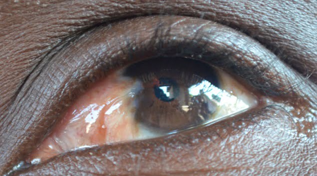 UN-OEIL-ATTEINT-PAR-LA-CATARACTE